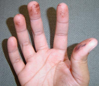 Apply 1 mL silver nitrate liberally and messily to one hand.  Wash vigorously.  Note observations.